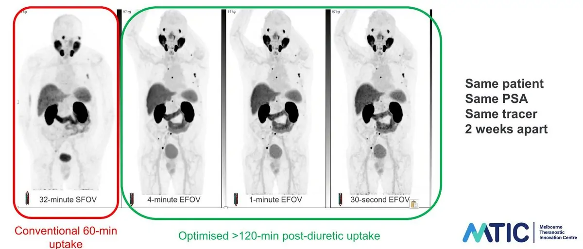 Two PSMA-PET scans of the same patient two weeks apart, conventional versus extended field-of-view